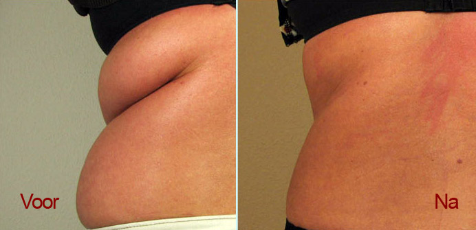 cavitation